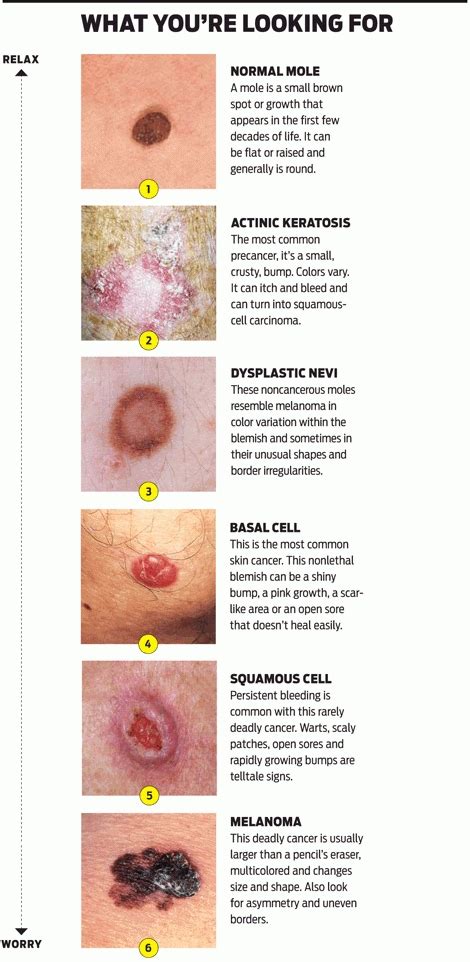 Are Most Skin Cancers Curable Cancer News Update