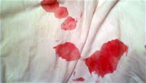 Blood In The Semen Haematospermia The British Association Of Urological Surgeons Limited