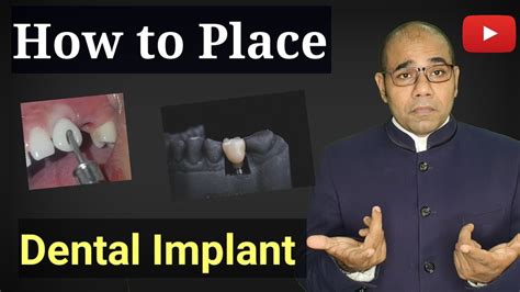 Learn Dental Implant Step By Step On Typodont Youtube