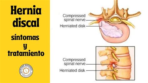 Hernia discal síntomas y tratamiento de la hernia discal cervical y