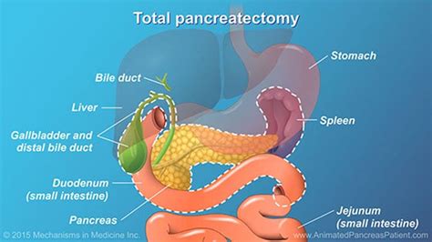 In A Total Pancreatectomy The Entire Pancreas Is Removed Together With