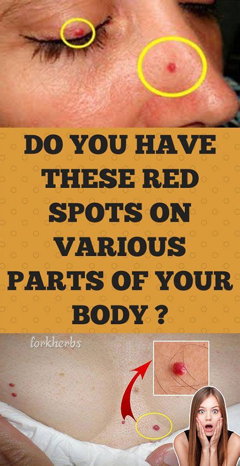 Do You Have These Red Spots On Various Parts Of Your Body Skin Spots