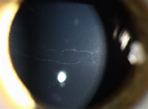 Posterior Polymorphous Corneal Dystrophy Symptoms Nspdd