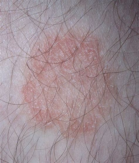 A Home Remedy For Ringworm That Works Home Remedies For Ringworm