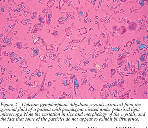 Figure 1 From Leader Identification Of Crystals In Synovial Fluid