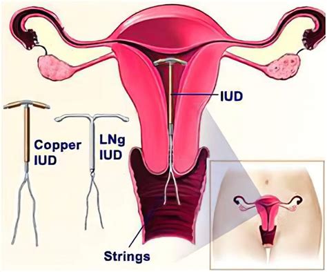 All About IUD Or Intrauterine Device Ultrasoundfeminsider