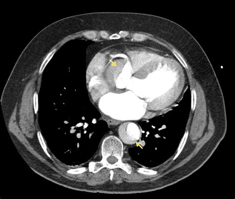 Aortic Dissection Spontaneous