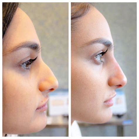 Skincare Nose Fillers Nonsurgical Nose Job Rhinoplasty Nose Jobs
