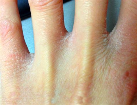 Трескается кожа на пальцах рук и лопается причины и лечение
