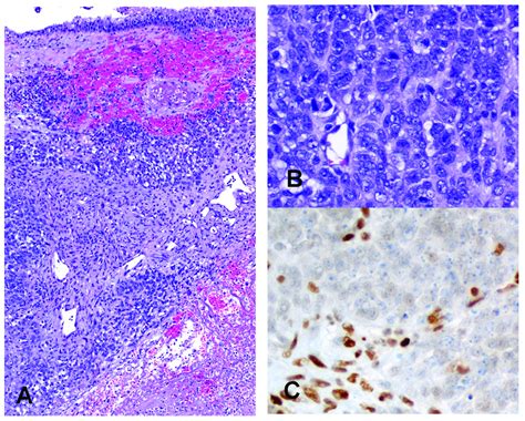 Smarca Deficient Sinonasal Carcinoma Nests Of Undifferentiated Tumor