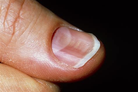 Nail Problems Nhs