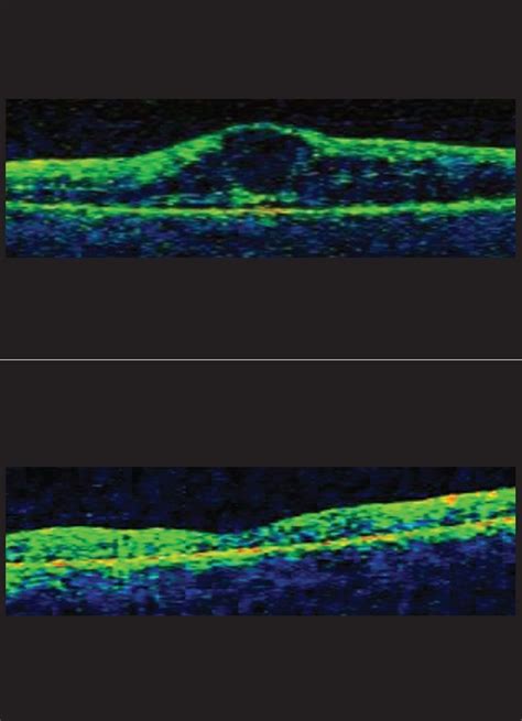 Intravitreal Bevacizumab Avastin Treatment Of Diffuse Diabetic