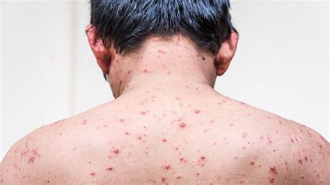 Chickenpox In Adults Risk Factors Symptoms Complications Treatment