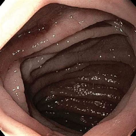 Upper Gi Endoscopy Showing Scalloped Duodenal Folds Download Scientific Diagram