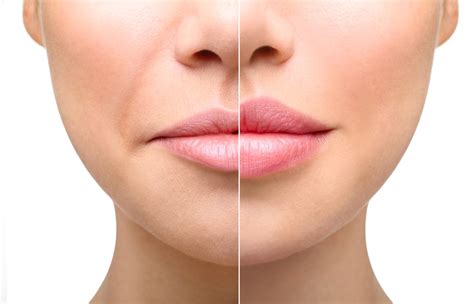 Everything You Need To Know About Lip Fillers Jiva Med Spa