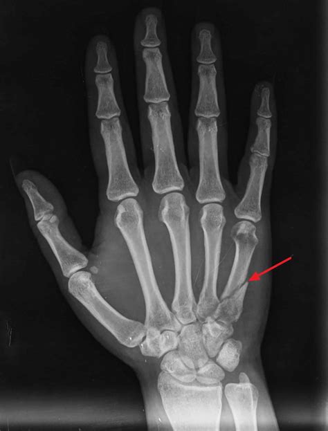 Metacarpal Bone Fracture