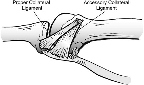 Etiology And Management Of Lesser Toe Metatarsophalangeal Joint