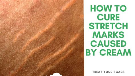 How To Cure Stretch Marks Caused By Cream Treat Your Scars