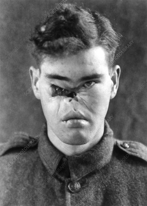 Facial Wound On A World War I Soldier Stock Image N800