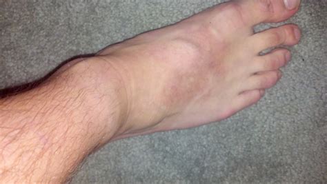 Discoloration On Top Of Foot No Other Symptoms Foot Health Forum