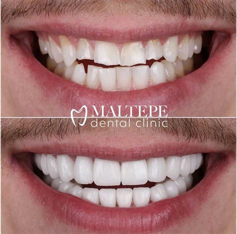 The Teeth Reshaping Procedure What To Expect Maltepe Dental Clinic