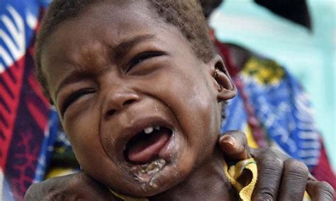 Malnutrition Brings A Terrible Disease To Children In Niger World