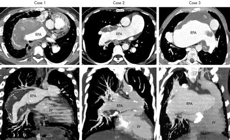 Massive Pulmonary Artery Thrombosis With Haemoptysis In Adults With