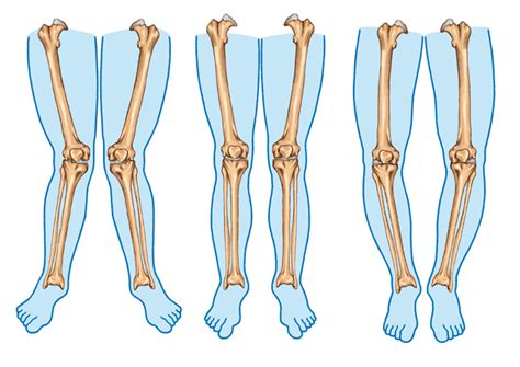 Explainer What Causes Knock Knees And Do They Have To Be Treated