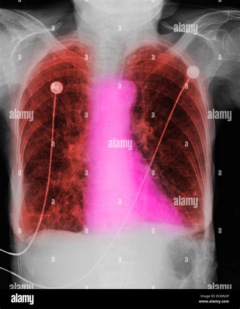 Chest X Ray Showing Chronic Obstructive Pulmonary Disease Stock Photo