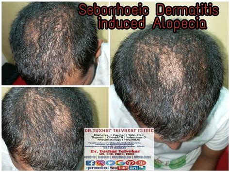 Seborrheic Dermatitis Hair Loss Before And After Lahoma Dowd