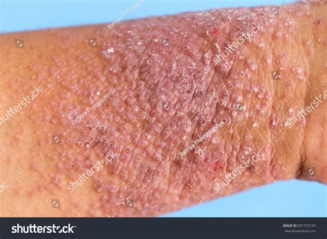 Hand Dermatitis Eczema On Hand Stock Photo 691372195 Shutterstock