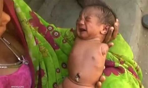 Baby Born With No Limbs Doing Well After Birth In India World News Express Co Uk