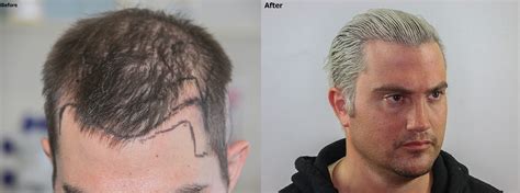 Temple Closure Hair Restoration For Facial Framing Alvi Armani Hair