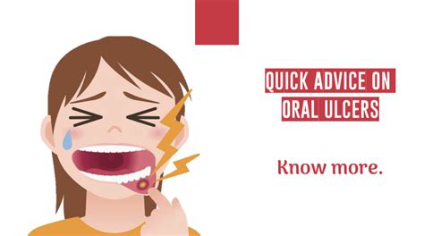 Quick Advice On Oral Ulcers In 60 Seconds Royal Dental Clinics Blog