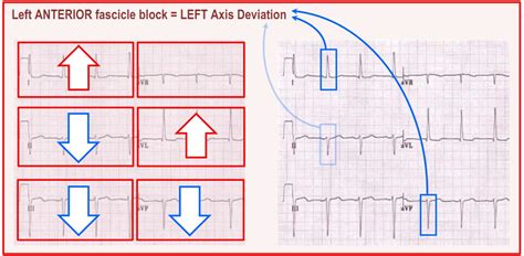 Left Anterior Fascicular Block Deranged Physiology