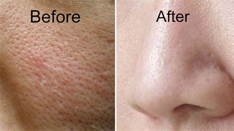 How To Get Rid Of Large Pores In Days Get Smooth Fairer And Tighter Skin Youtube