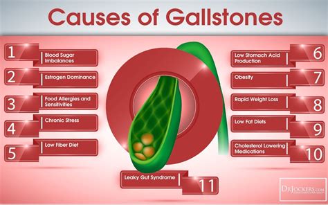 Beat Gallstones Naturally Gallbladder Symptoms Gallstones