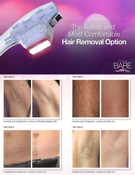 Ditch Your Razor For Laser With Forever Bare Bbl Harmony Wellness
