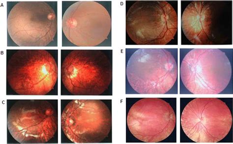 Photographs Of The Patients Fundus Appearance A Is The Fundus
