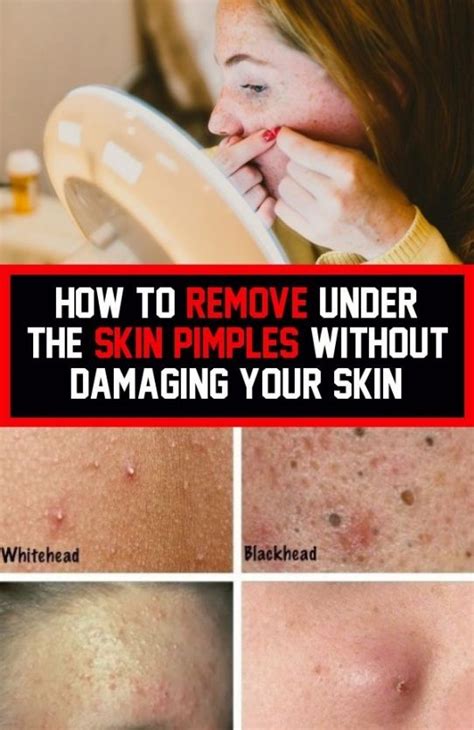 How To Remove Pimples Without Damaging Your Skin In 2020 Pimples