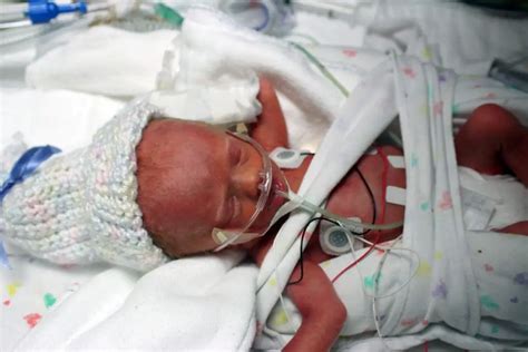 A Miracle The Worlds Smallest Premature Baby Is Finally Safe At Home