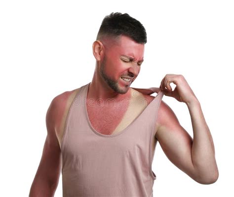 Man With Sunburned Skin On White Background Closeup Stock Photo