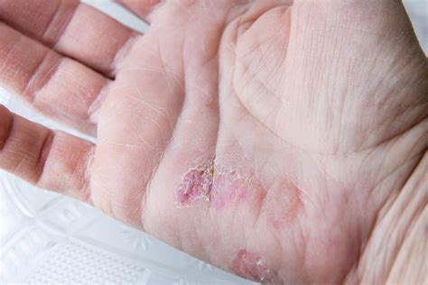 How To Get Relief From Winter Rash Cause Of Cold Rashes