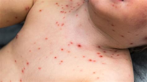 Chickenpox Overview Causes And Symptoms