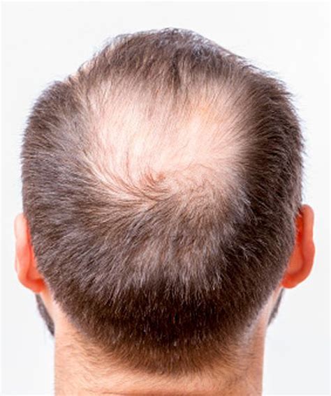 Diffuse Hair Loss Alopecia Causes Signs And Treatments Artofit