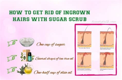 Do You Know How To Get Rid Of Ingrown Hairs Fast And Naturally This Is What You Need To Know