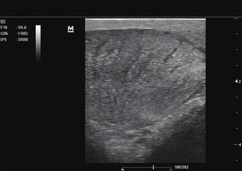 High Resolution Sonography 10mhz Of The Testicle Showing The Download Scientific Diagram