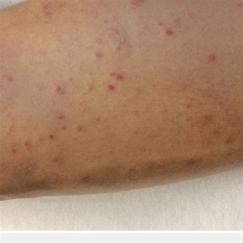 An Erythematous Non Pruritic Maculopapular Rash Scattered Diffusely On
