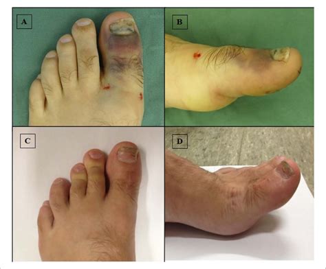 A B Preoperative Clinical Appearance Of The Swollen Left Hallux In A