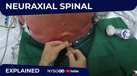 Neuraxial Spinal Anesthesia Ultrasound Assisted Regional Anesthesia